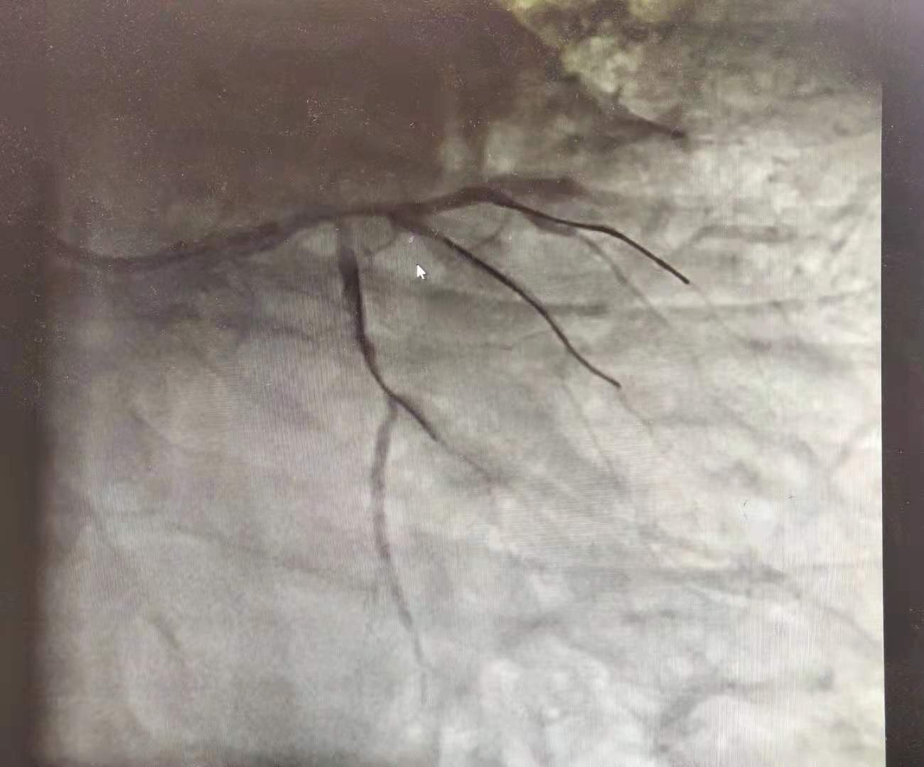 胃痛一个月后突发心梗,大夫心梗误诊胃病致死