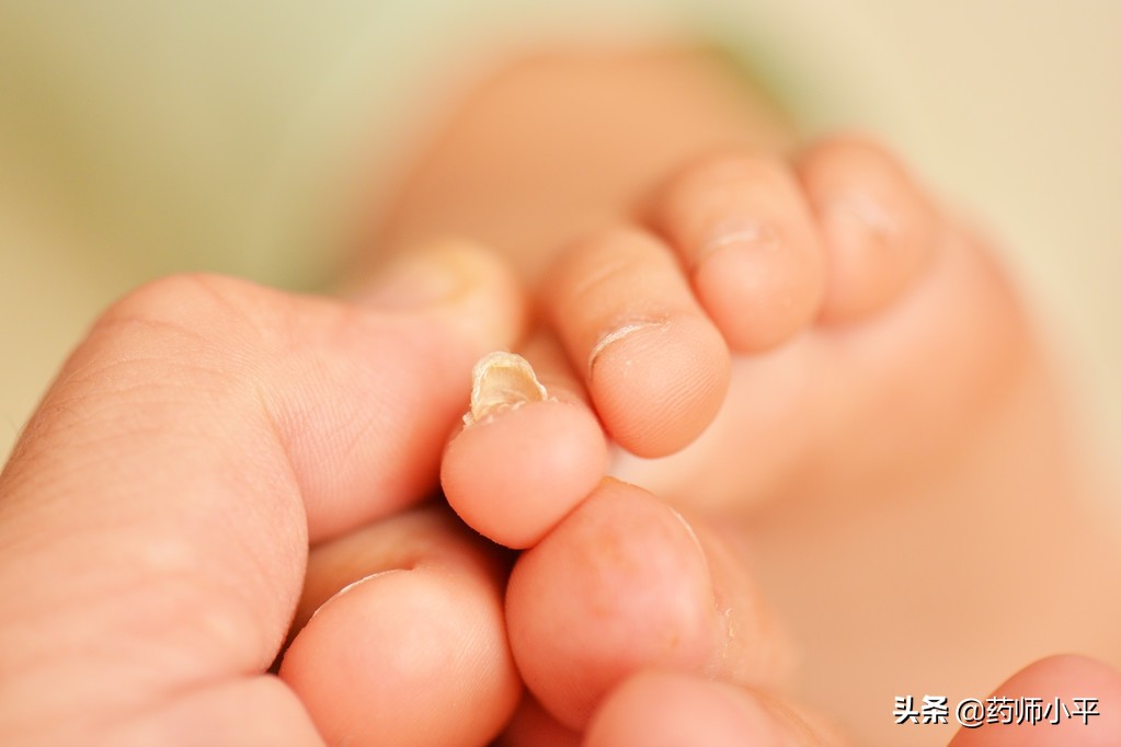 脚气水预防灰指甲么,脚气和灰指甲一站式解决