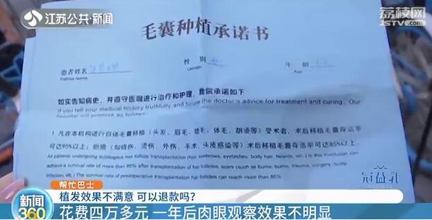 花一万多植发一年后头发没了,花4万植发却发现缺一块