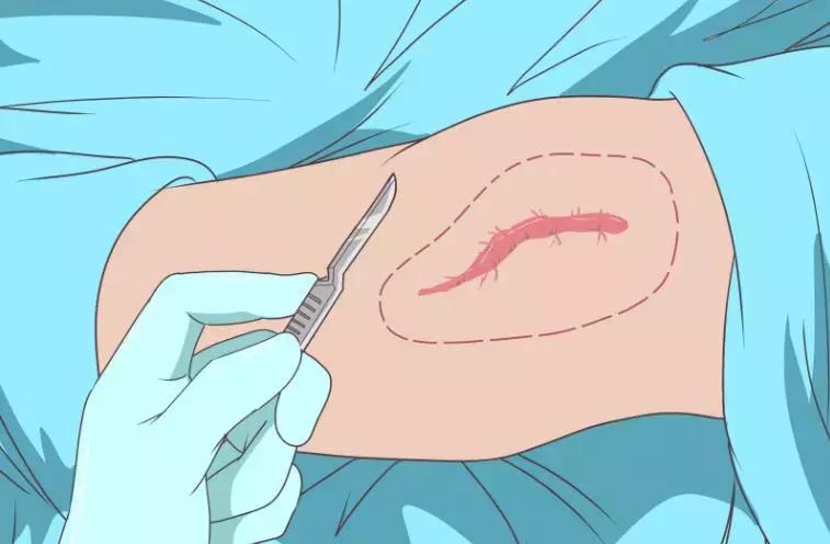 抗疤痕药什么价格,进口祛疤痕药