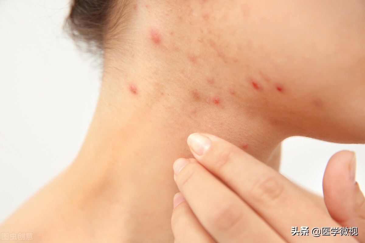 长得像瘊子一样的痘痘怎么回事,身上出类似瘊子的痘痘是什么原因