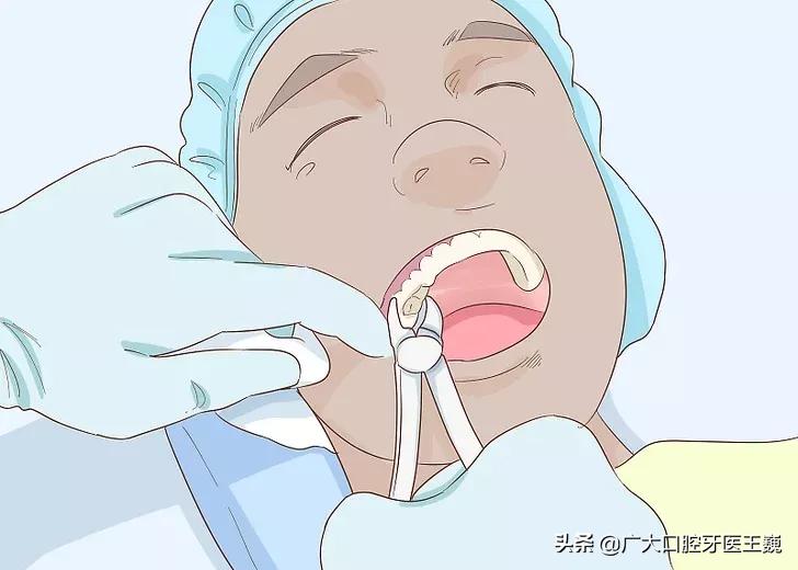 烤瓷牙里面的牙齿腐烂视频,牙齿从牙根开始腐烂怎么办