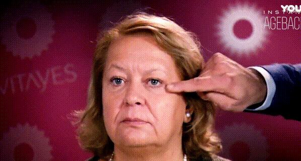 护肤黑科技顶级医美,用黑科技去除眼袋肿了十天