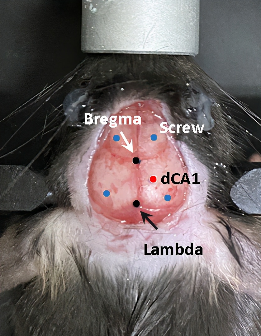 晶体植入手术的分享,可调微丝阵列电极