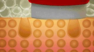 打水光针和打除皱针哪种好,打水光针和除皱针哪个好