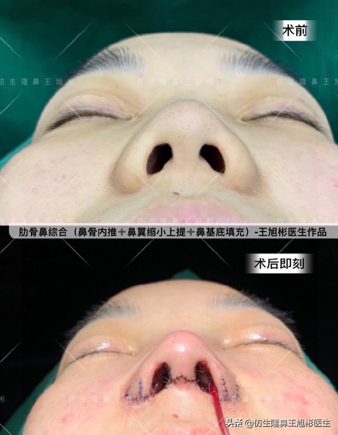 短鼻延长,短鼻塌鼻可以逆袭变长吗