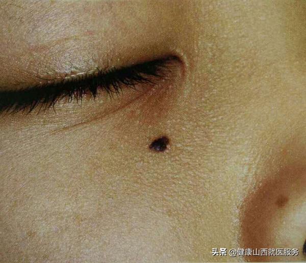 激光点掉的痣会恶变吗,激光点痣会诱发痣癌变是真的吗