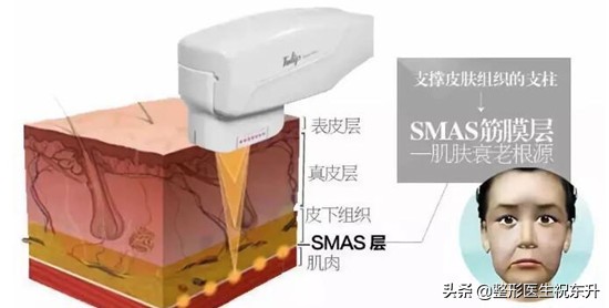 超声刀为什么一个月才能看到效果,超声刀真的会有效果吗