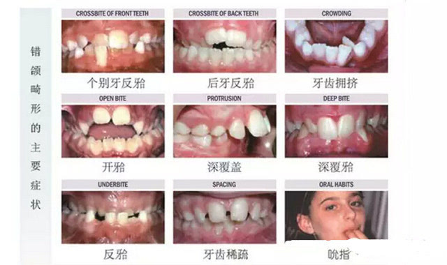 成年人牙齿错颌畸形怎么治,6岁孩子牙齿畸形怎么样矫治
