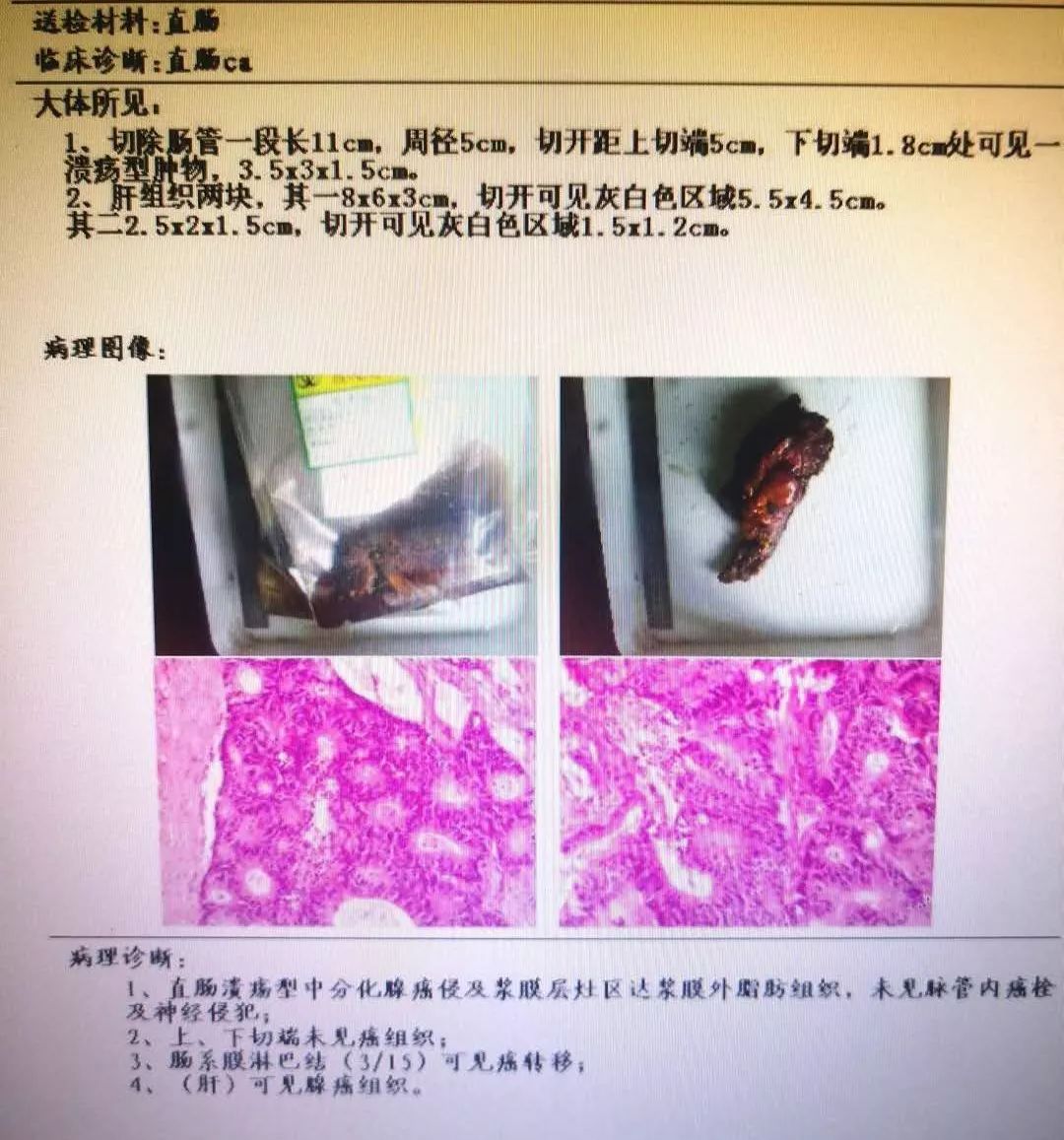县中医院首例腹腔镜手术圆满成功,直肠癌腹腔镜手术成功案例