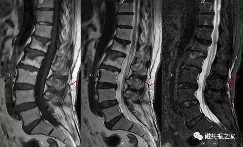 腰椎有哪些病变,腰椎病变有几种