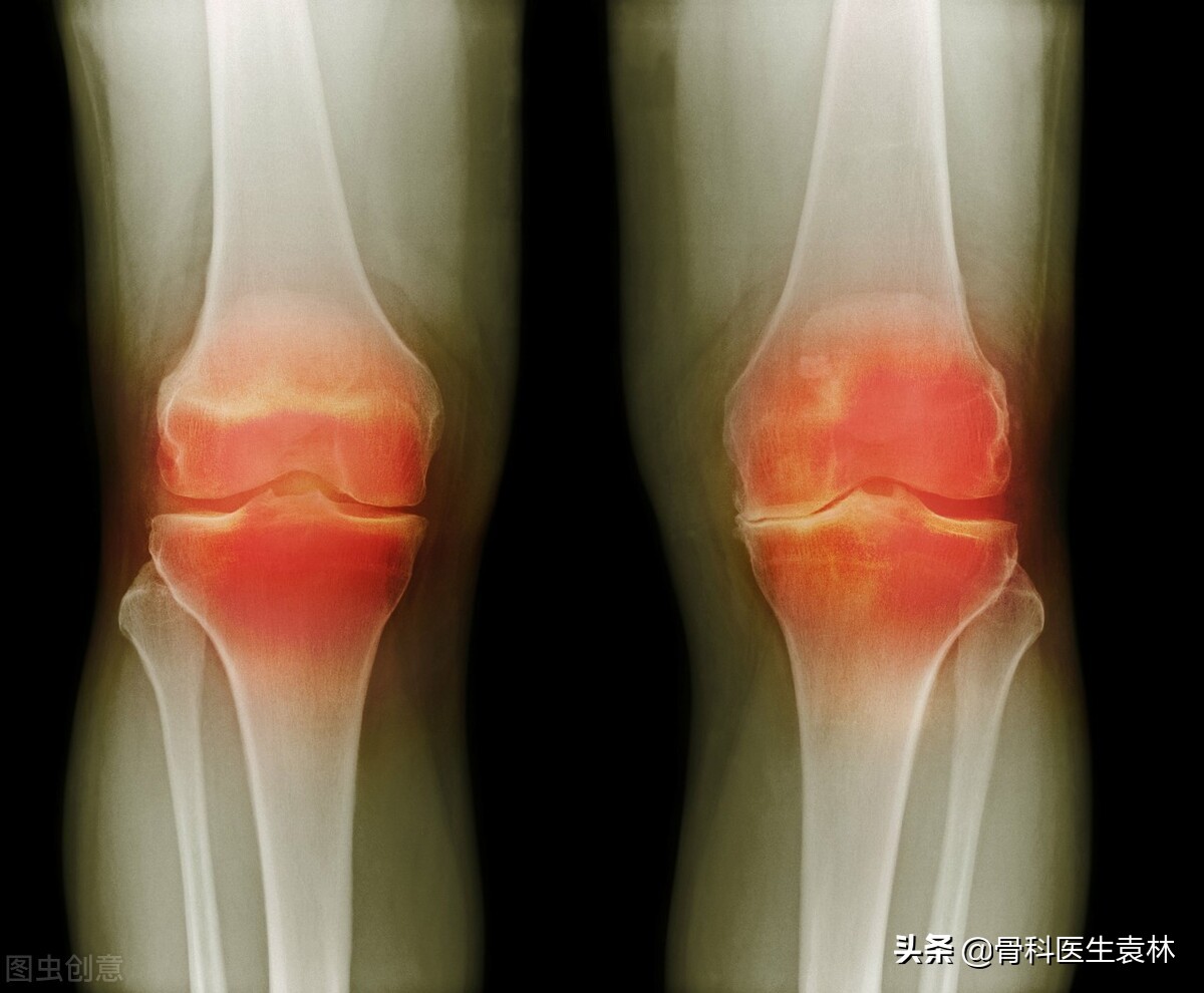 如何判断骨关节炎的严重程度,骨关节炎与关节炎有什么不一样