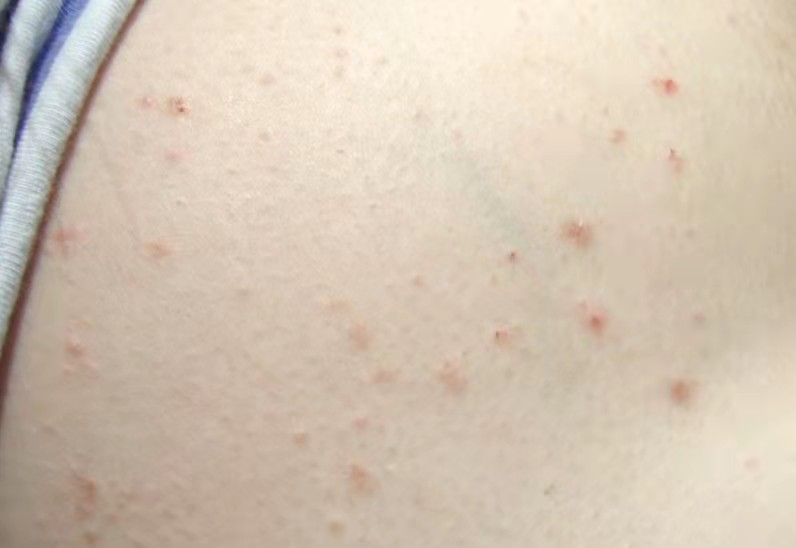 点滴型银屑病皮损为什么会变大,银屑病治疗过程中变成丘疹