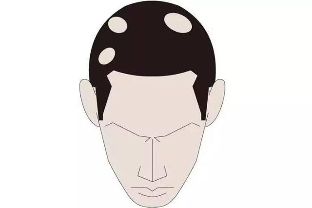 脱发严重是身体哪出问题了,脱发了好可怕