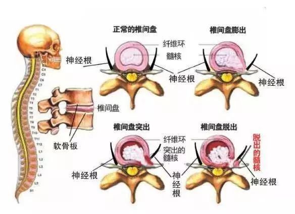 椎间盘突出还能恢复吗,得了椎间盘突出还能干活吗