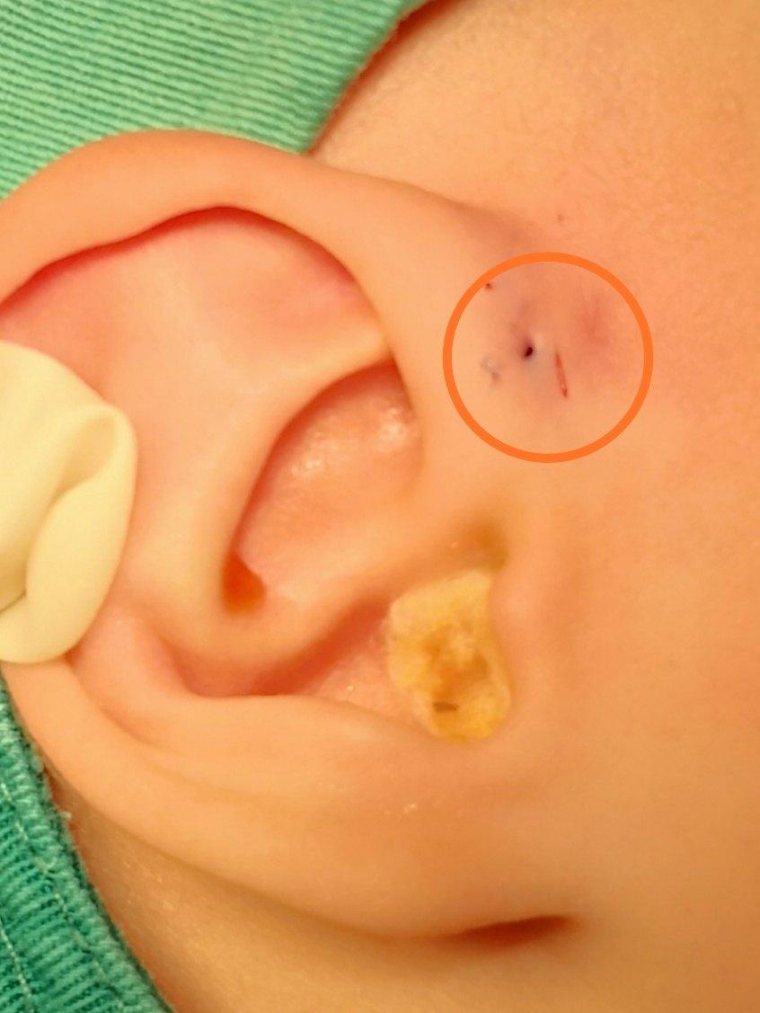 宝宝耳朵上有个小孔图,宝宝耳朵里面有个小印子