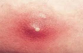 挤痘痘之后的正确处理方式,挤痘痘后正确处理方法