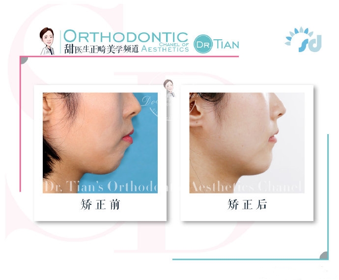 西安哪里有做牙齿矫正,在西安哪里可以做牙齿矫正