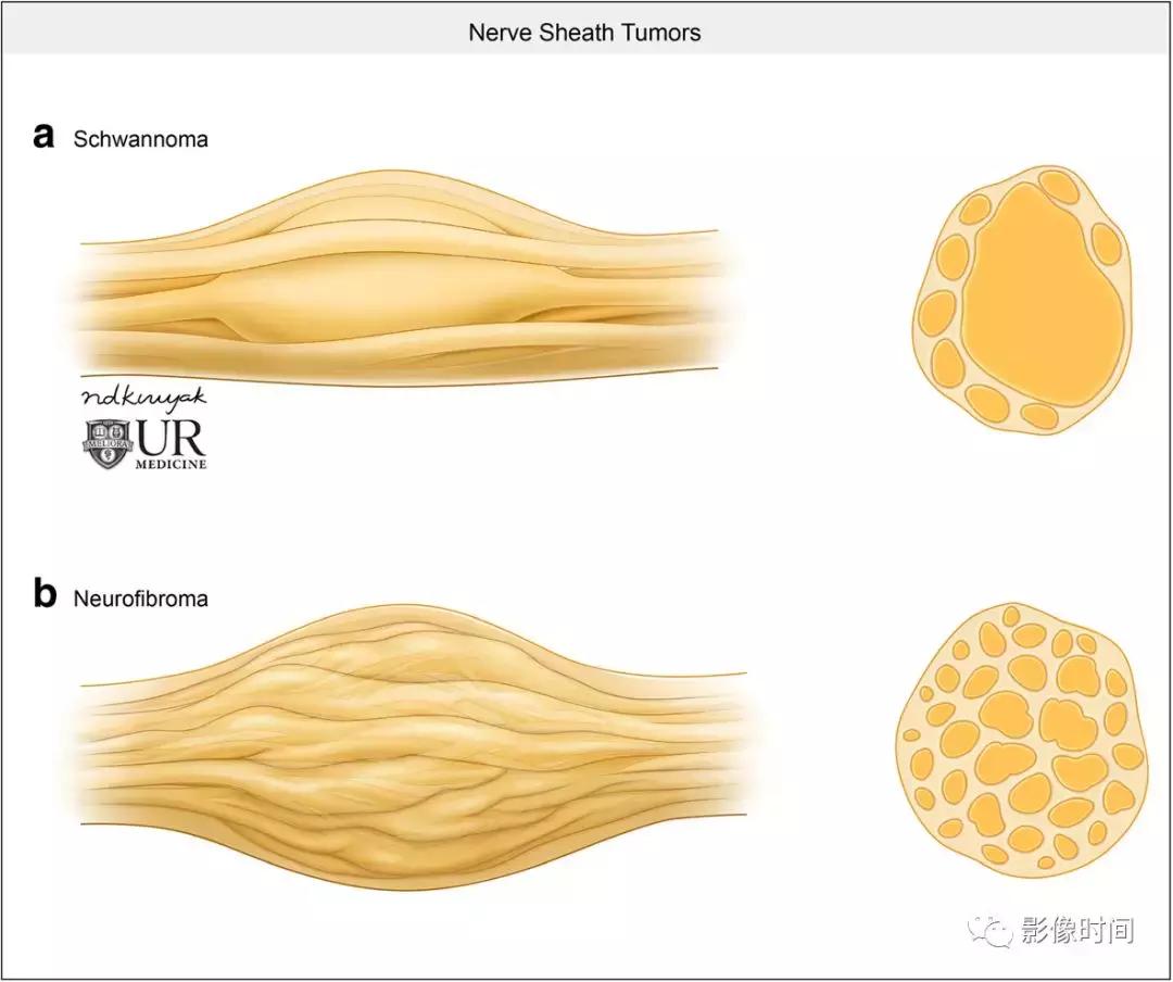 双侧颈动脉鞘间隙多发小淋巴结影,双侧颈动脉间隙多软组织密度结节