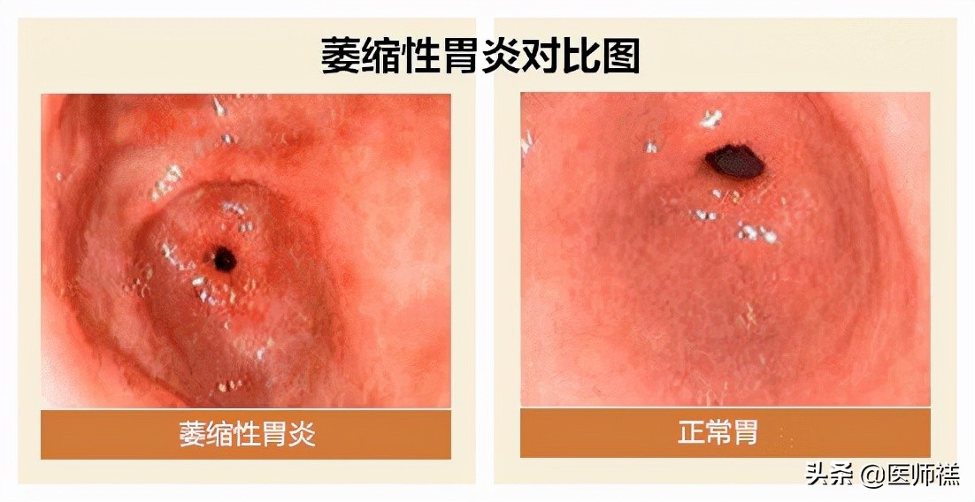 胃炎迁延不愈,胃炎久治不愈需要再做胃镜吗