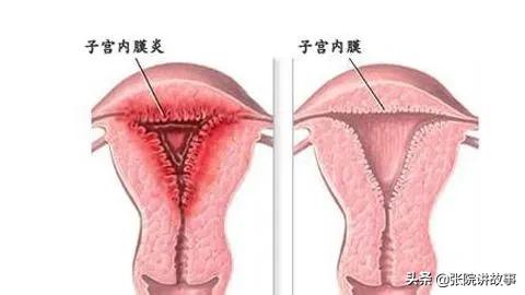「张院讲故事」子宫内膜炎是如何导致女性不孕的？
