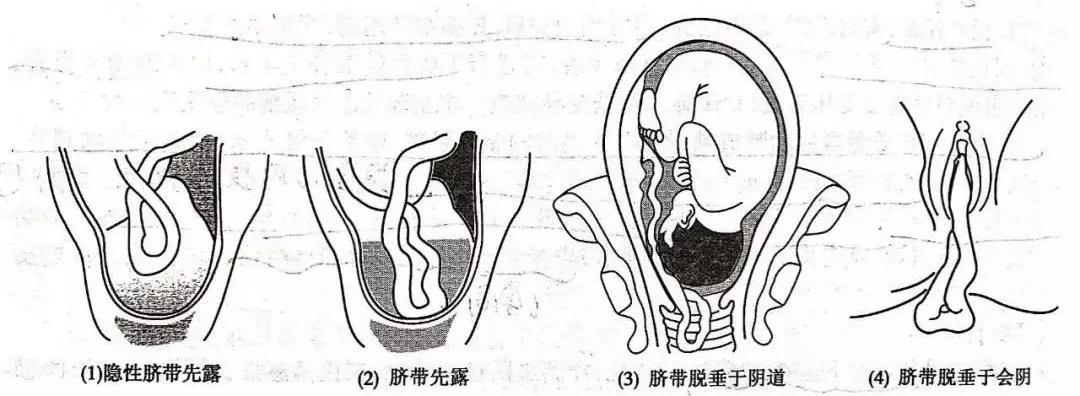 婴儿出生十天脐带未脱落且有血,婴儿脐带脱垂命悬一线