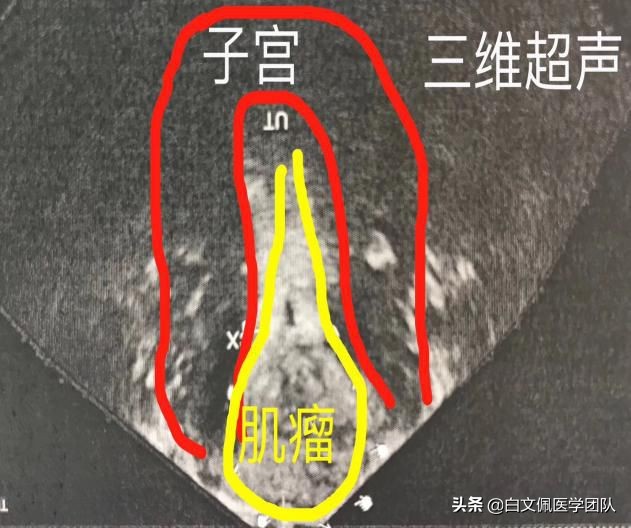 腹腔镜妇科解剖教学视频教程,白文佩医学团队