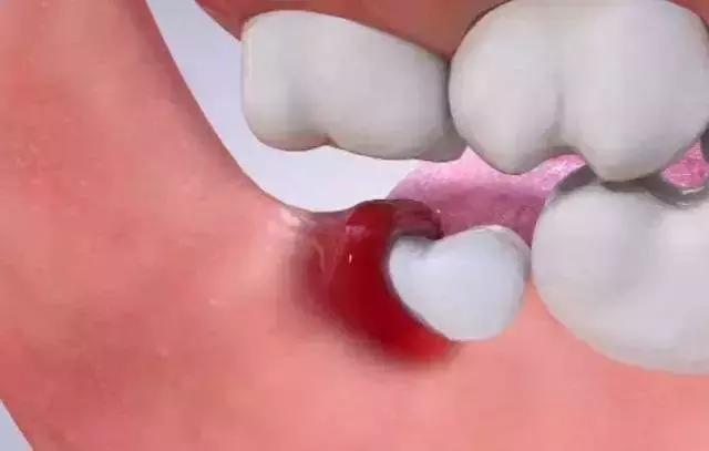 那些不拔智齿的人后来都怎么样了,那些该拔不拔的智齿最后都咋样了