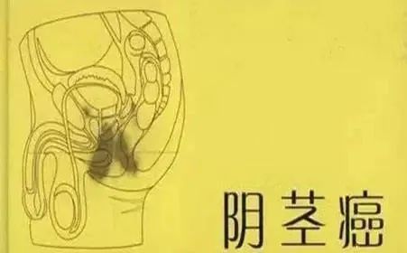 直肠癌与hpv感染有关么,hpv感染和脚气有关吗