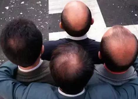 拿什么拯救你我的发际线笑死我了,拿什么拯救你我的发际线文案