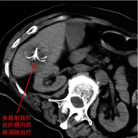 患癌必死无疑？错！善用介入疗法，恶性肿瘤患者长期生存不是梦