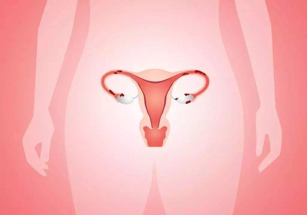 女人子宫没了,和正常人有什么区别?哪些疾病要进行子宫切除?