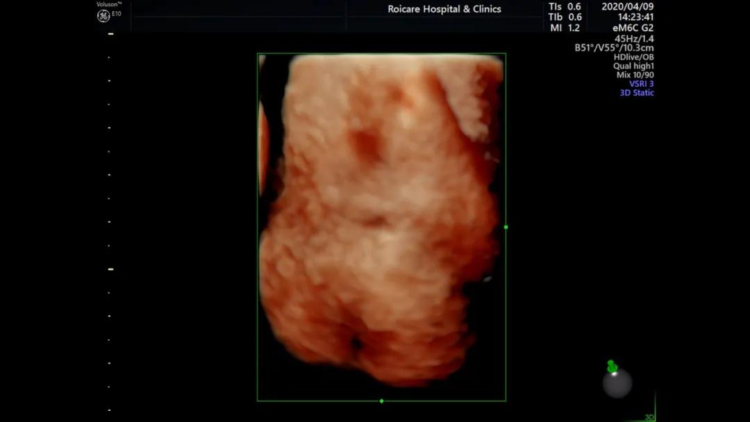 胎儿脊髓圆锥位置低是什么情况,胎儿脊髓圆锥位置偏低做核磁共振