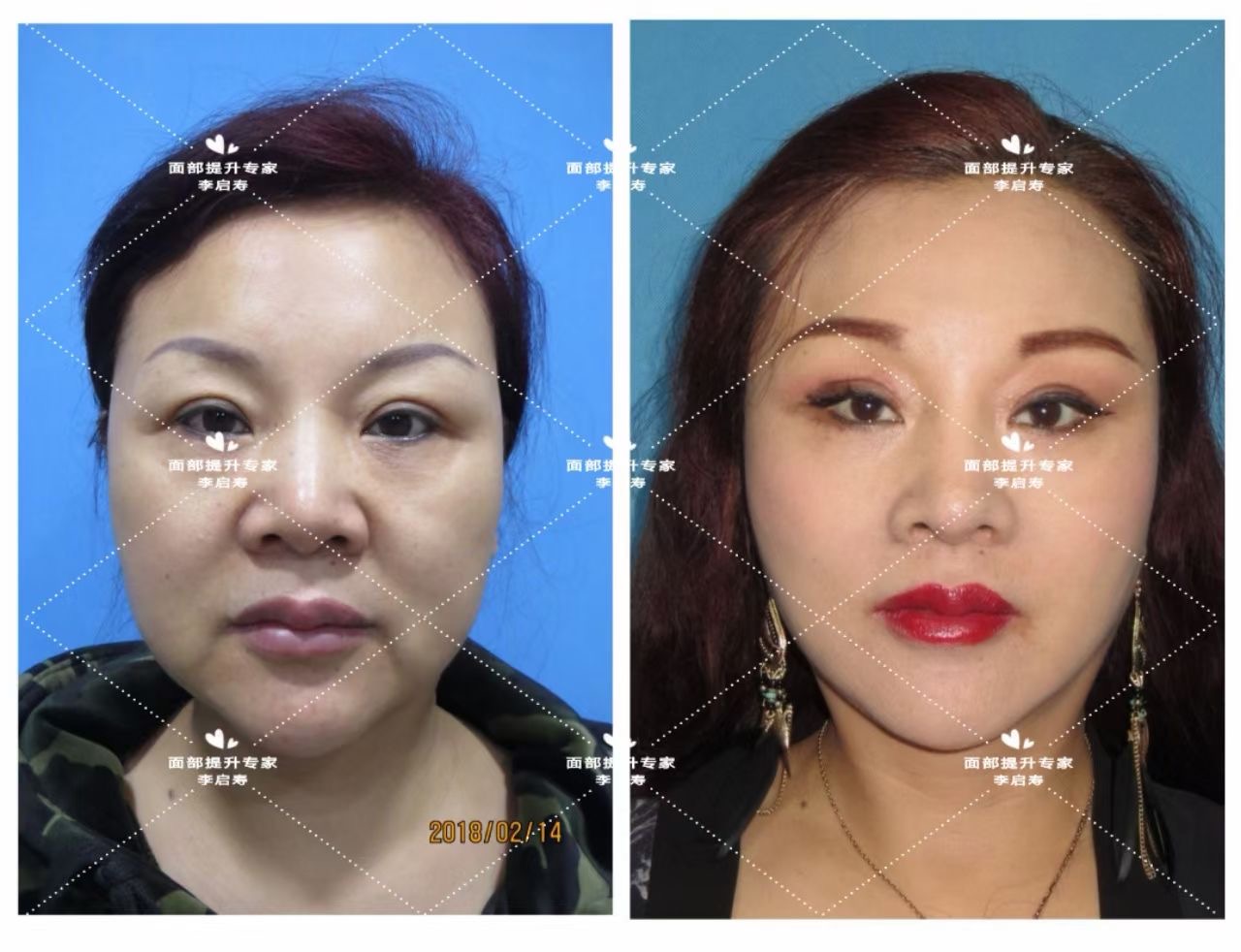 所有人都有咬肌肥大,脸颊咬肌肥大怎么办