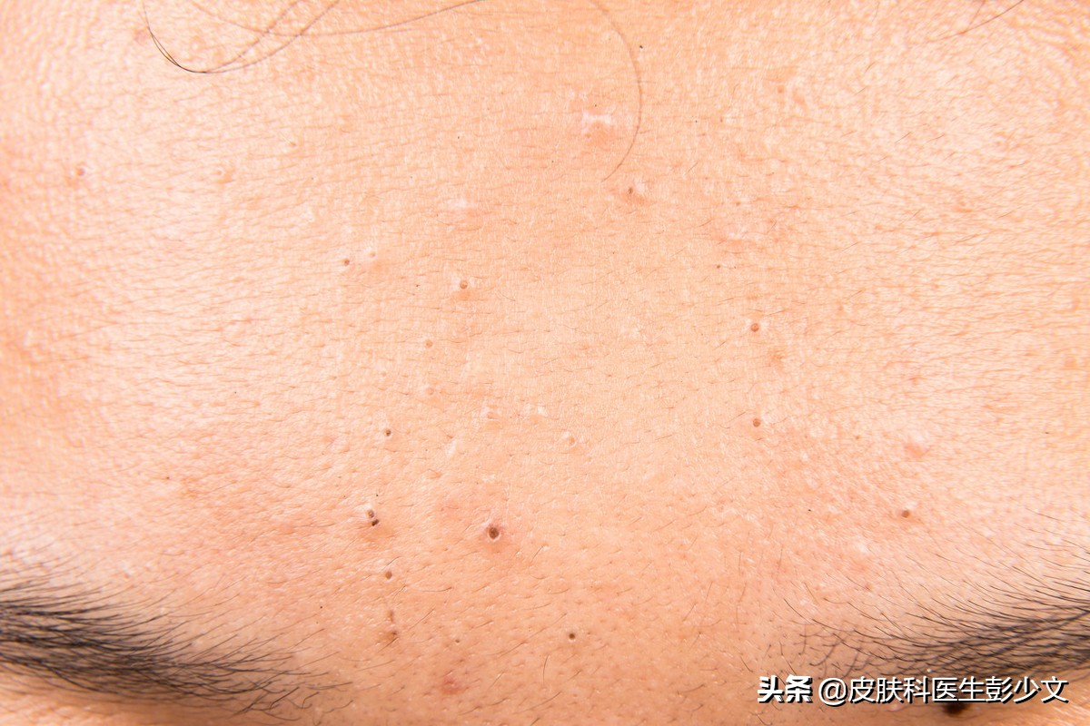 脸上痤疮用哪种外用维a酸类药物,治疗痤疮的维a酸类药