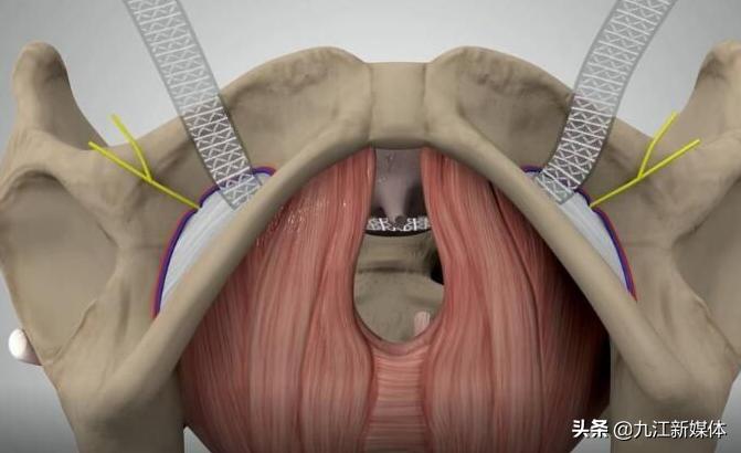 打个喷嚏就漏尿怎么回事呢,打个喷嚏就漏尿要怎么办呢