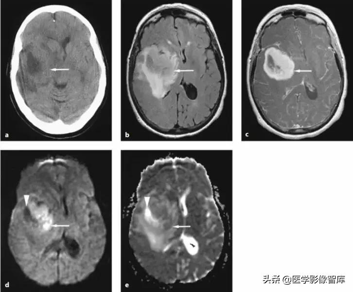 双侧额叶皮层区dwi偏高是什么意思,颅内dwi高信号病变