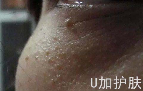 脸上的油脂粒如何去除,怎样有效去除脸上的油脂粒