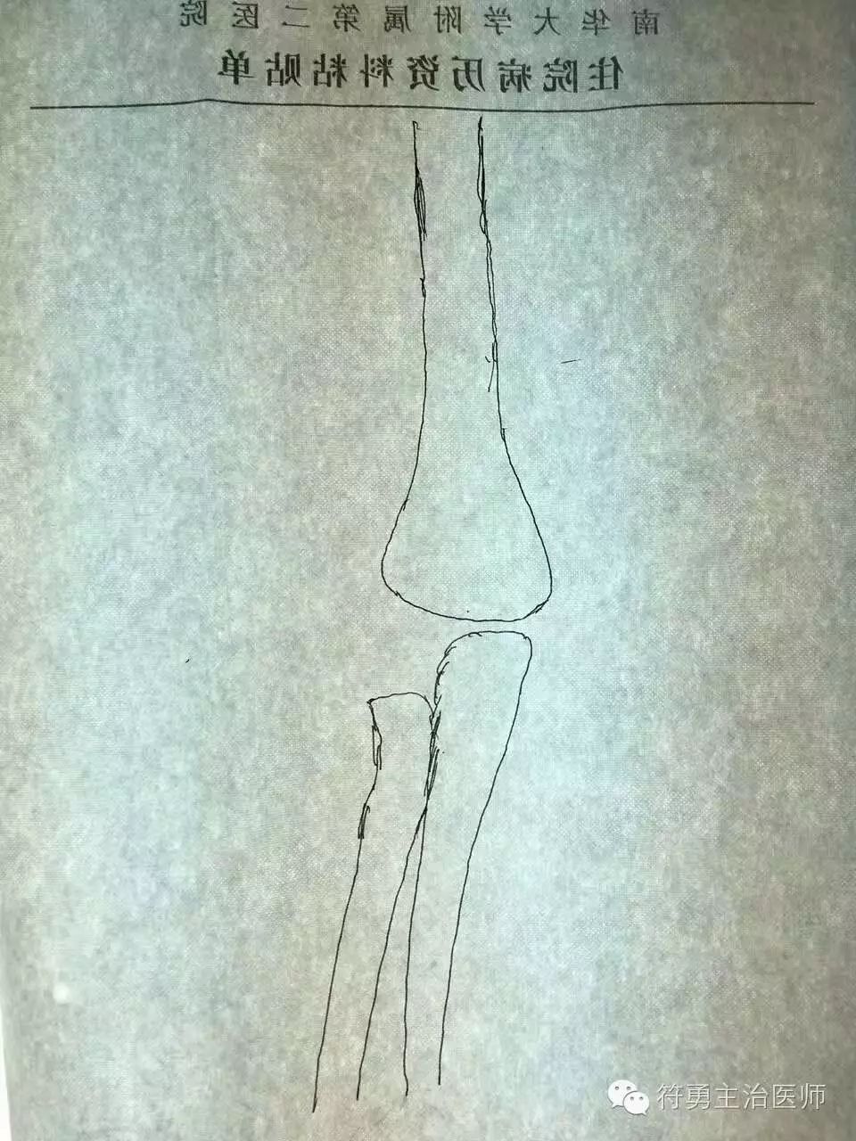 手臂肘内翻的手术效果,胳膊肘内翻矫正手术28年费用