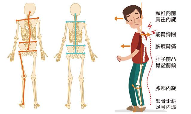 骨盆歪造成的脸歪能恢复吗,骨盆为什么会前倾最快纠正法