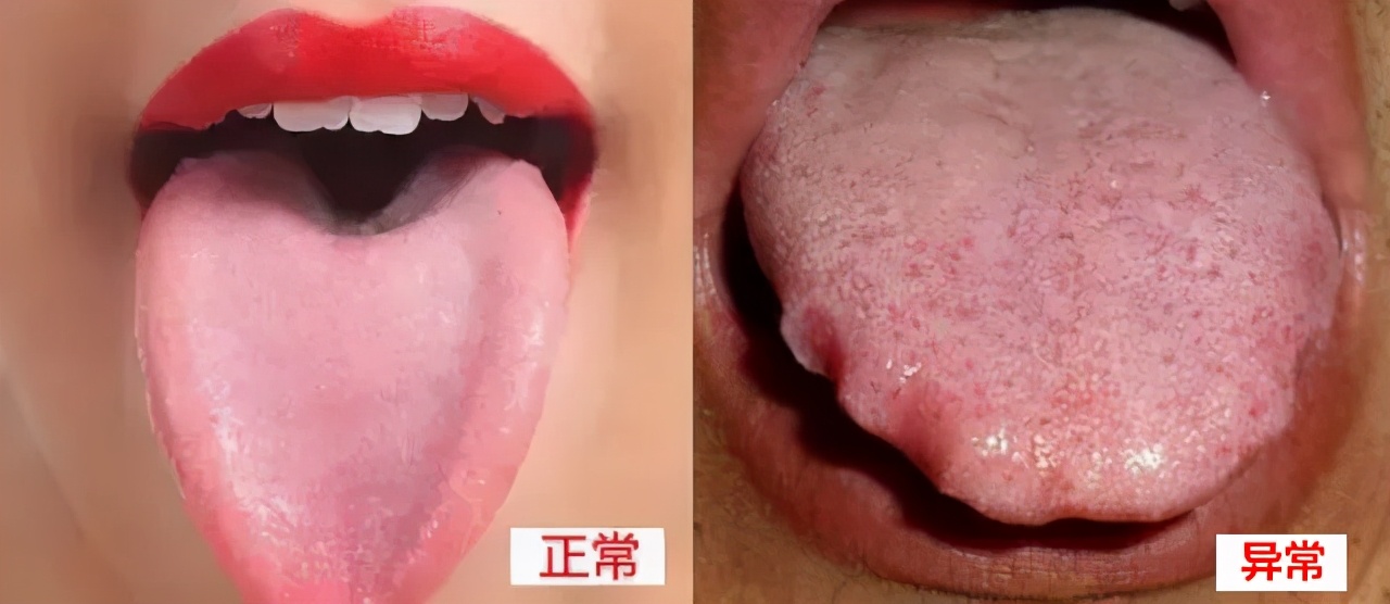 湿气重引起的乏力怎么办,浑身犯困乏力是不是因为湿气太重