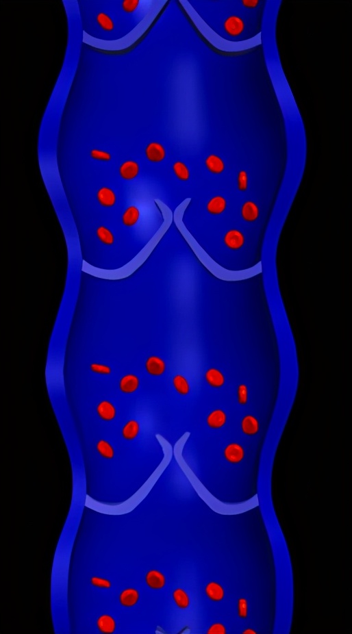 工作引起静脉曲张怎么办,下肢静脉曲张属于职业病吗