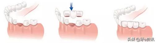 烤瓷牙价格表图种植牙,种植牙与烤瓷牙利与弊