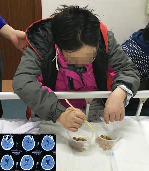 结核性脑积水,脑膜炎脑积水要治疗多久