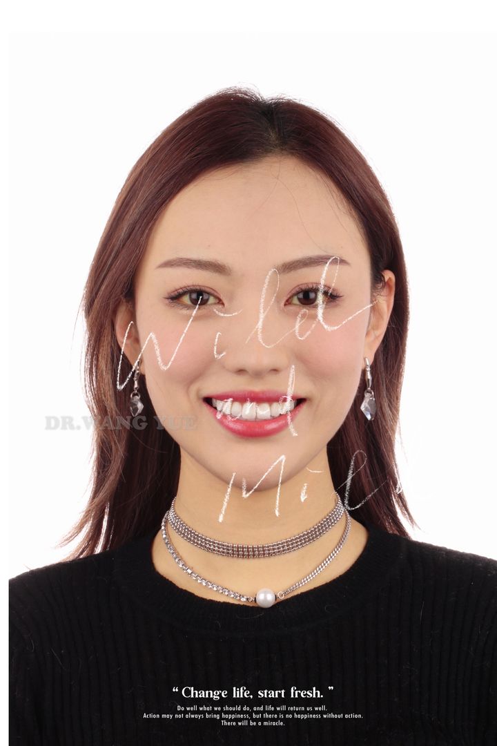 从新一代金庸女神文咏珊看正畸美学中的微笑｜上海牙齿矫正