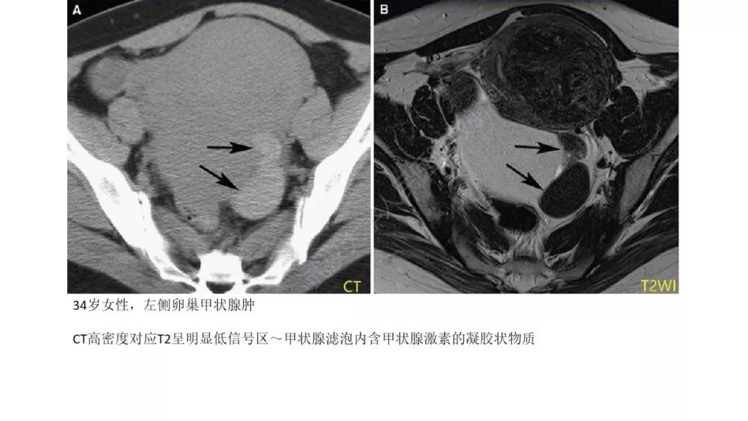 卵巢原发肿瘤的分析思路