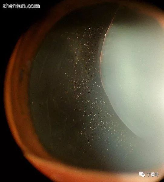 马凡综合征面容,马凡综合征最新标准