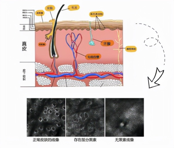 长这三种痣可能和癌症有关,长在这8个部位的痣需要注意了