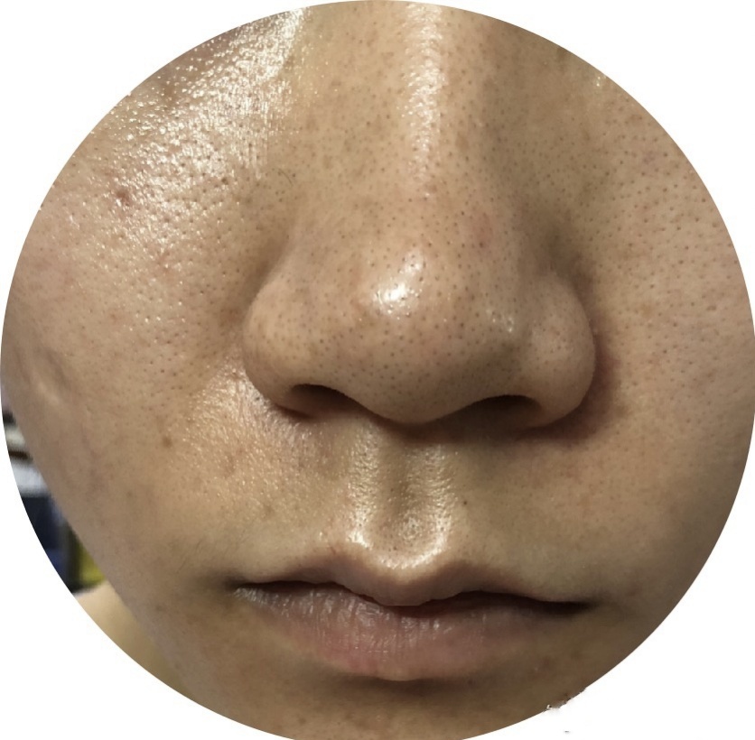 油皮毛孔粗大毛孔多要怎么改善,油皮毛孔粗大护肤品