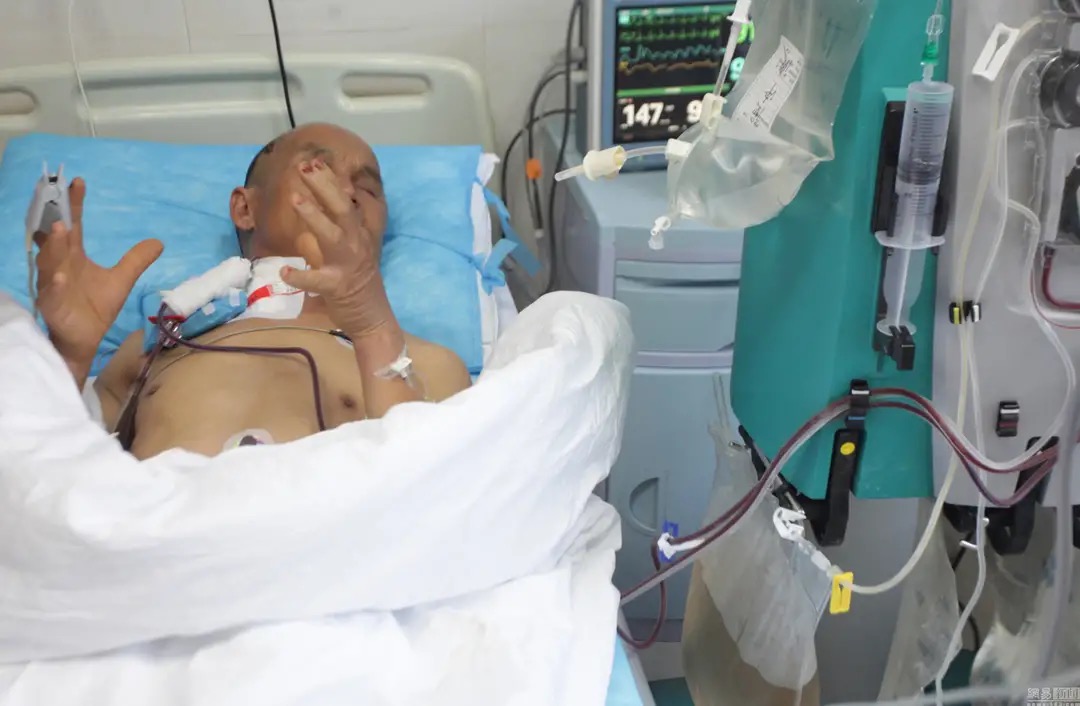 被马蜂蛰伤就医,被马蜂蛰伤休克